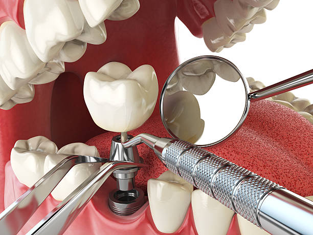 Best Emergency Dentist for Lost Fillings or Crowns in Beach Haven, NJ